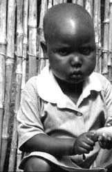 Zagodzone dziecko rwandyjskie z obrzkami godowymi (kwasiorkor)