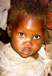 Niedożywiona sierota z Rwandy. Odbarwiające się włosy, opuchnięta twarz i pękająca skóra to objawy choroby głodowej.