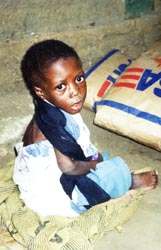 Kwasiorkor to choroba godowa, na ktr cierpi ten chopiec